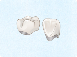 メタルセラミック　クラウン