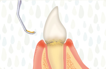 軽度歯周病
