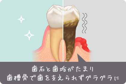 歯石と歯垢がたまり歯槽骨で歯を支えられずグラグラに