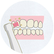 歯のクリーニング歯垢・歯石の除去