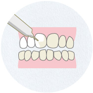 歯の表面にジェルを塗布