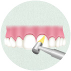 歯間や歯面をクリーニング